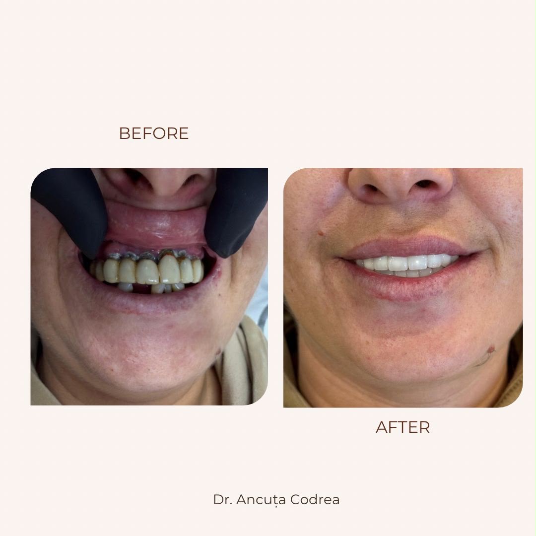 Înainte și după protetică dentară fixă