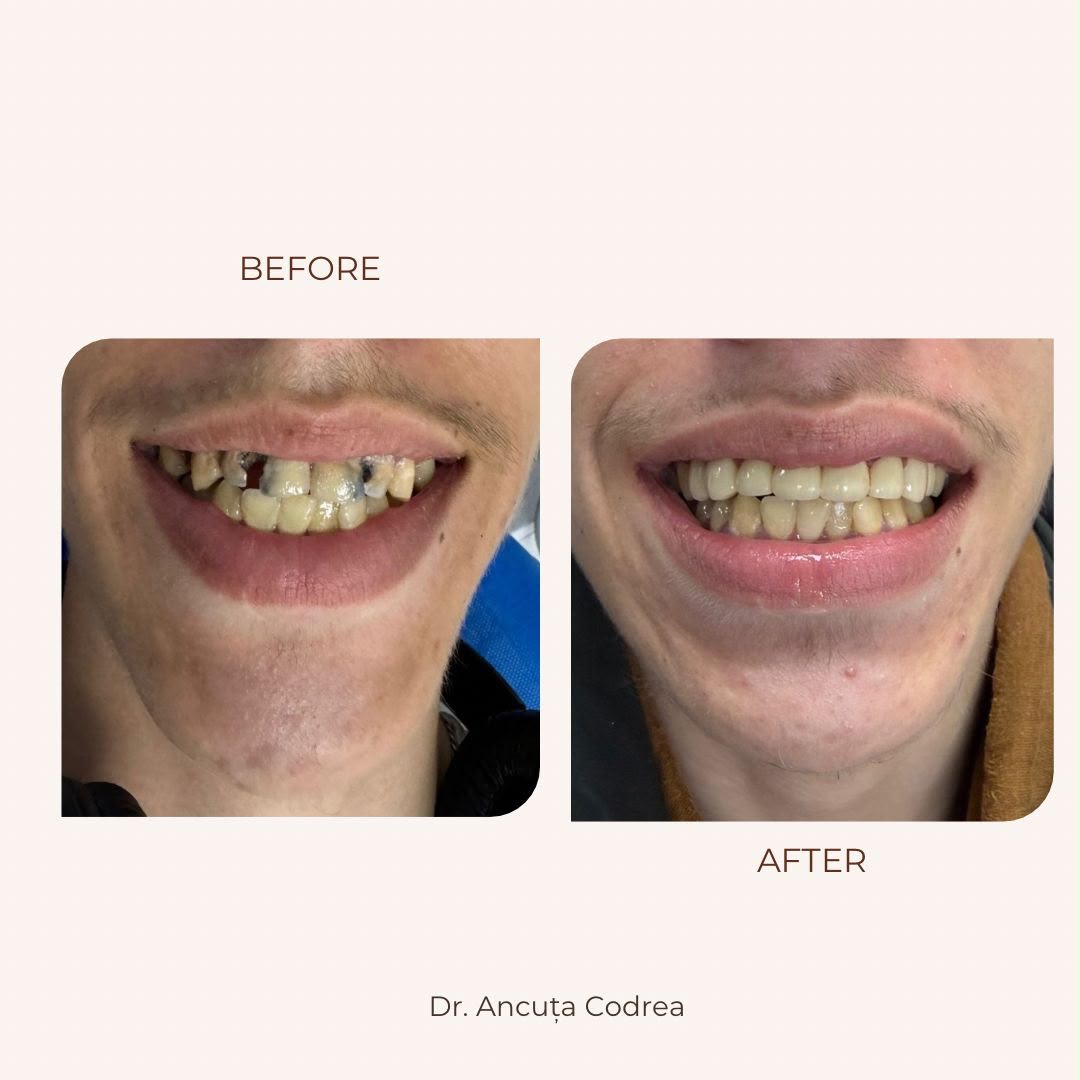 Înainte și după reconstrucție dentară cu coroane