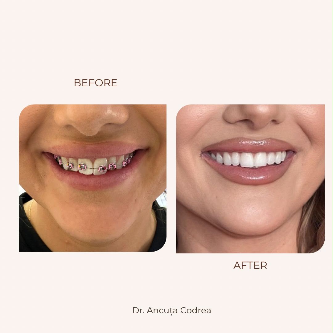 Înainte și după aparat dentar și estetică dentară