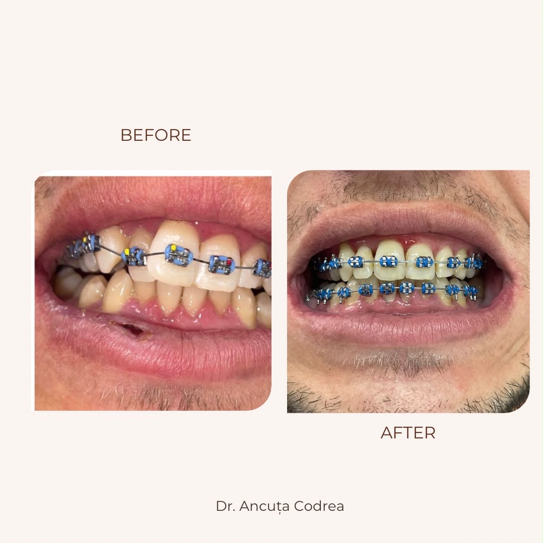 Înainte și după tratament ortodontic cu aparat dentar fix