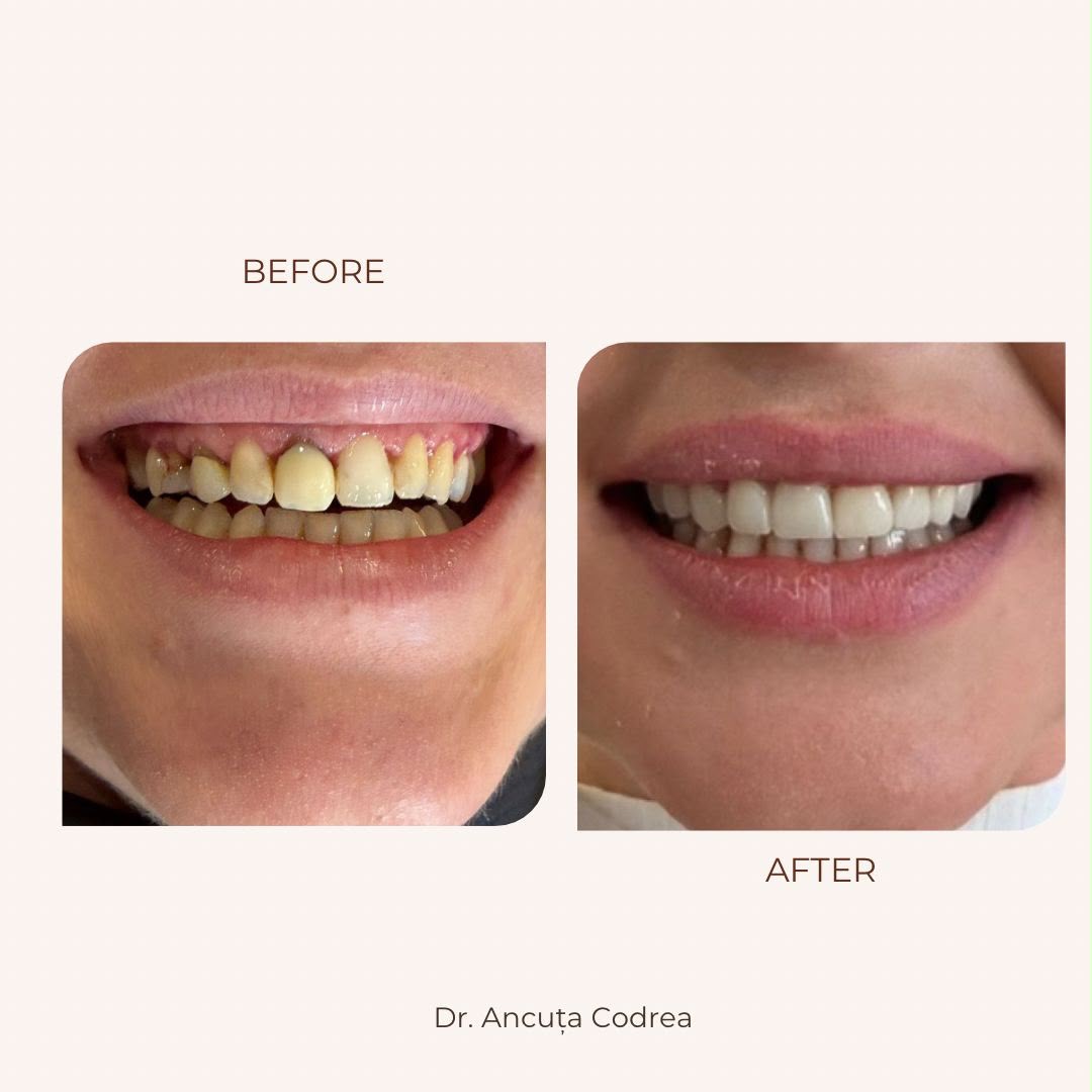 Înainte și după estetică dentară frontală