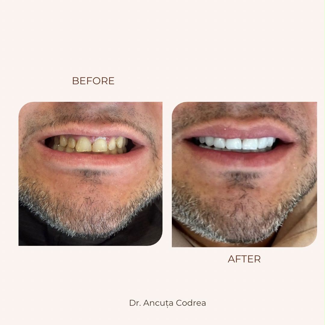 Înainte și după albire și estetică dentară